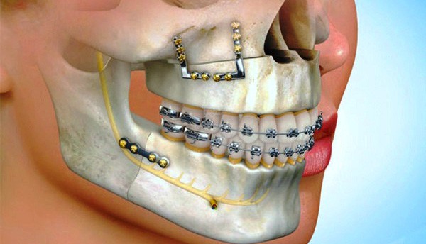 Surgical orthodontics - how it works?
